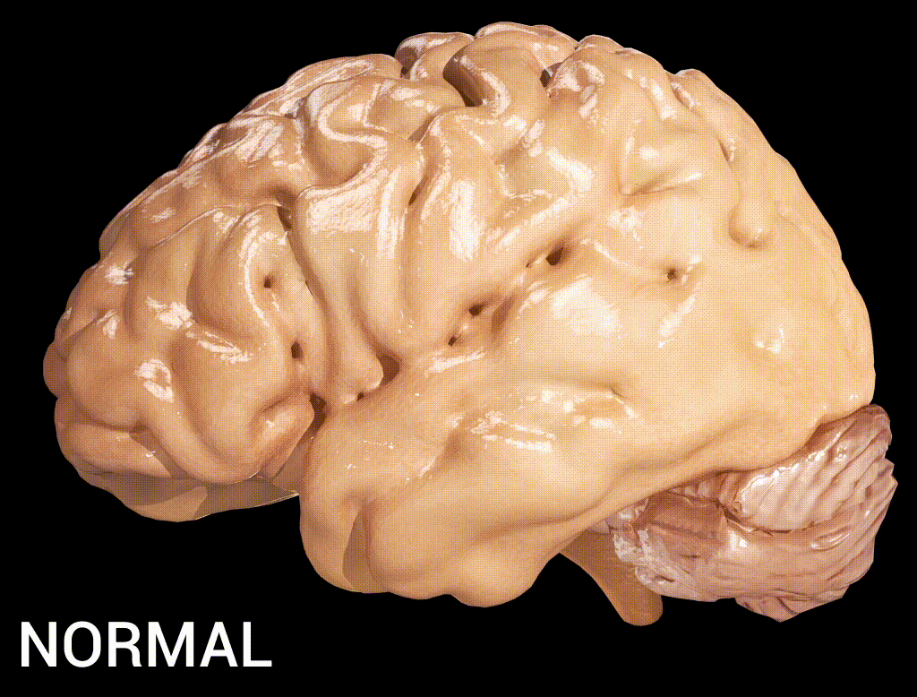 Alzheimer%27s_Disease.gif